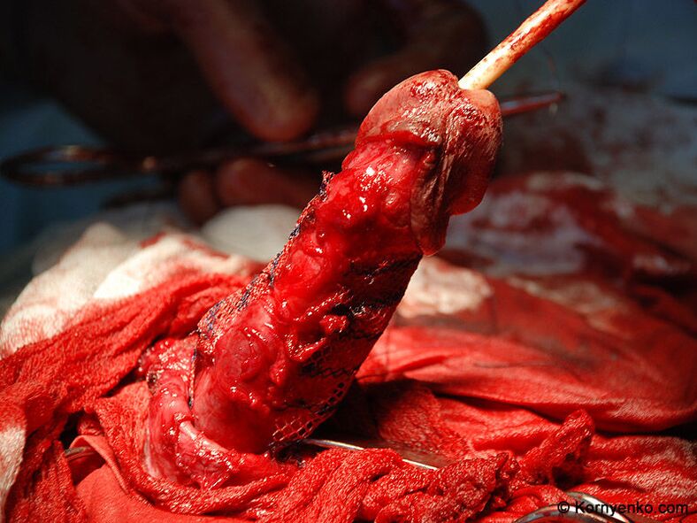 pose d'une matrice de collagène pour agrandir le pénis