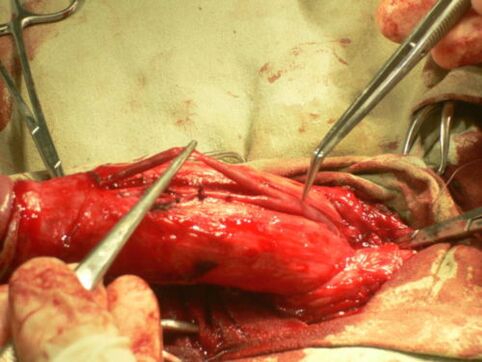 effectuer une opération d'agrandissement du pénis